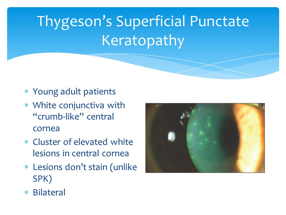 Cornea Remove: Thygeson's, dystrophies? (2), peripheral 