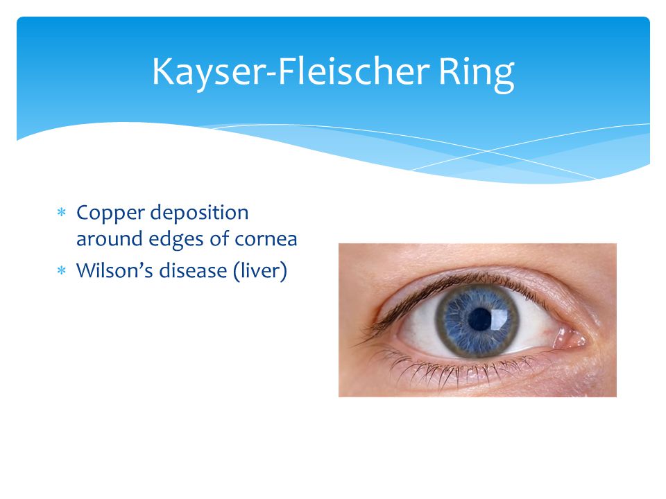 Cornea Remove: Thygeson's, dystrophies? (2), peripheral ulcerative  keratitis (2), surgery (intacs, CK, AK, PIOL, RLE, RK, etc.) Add NaFl  photo. - ppt video online download