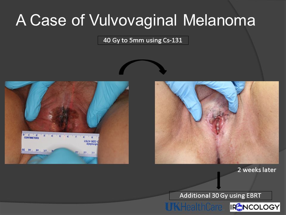 A Case of Vulvovaginal Melanoma