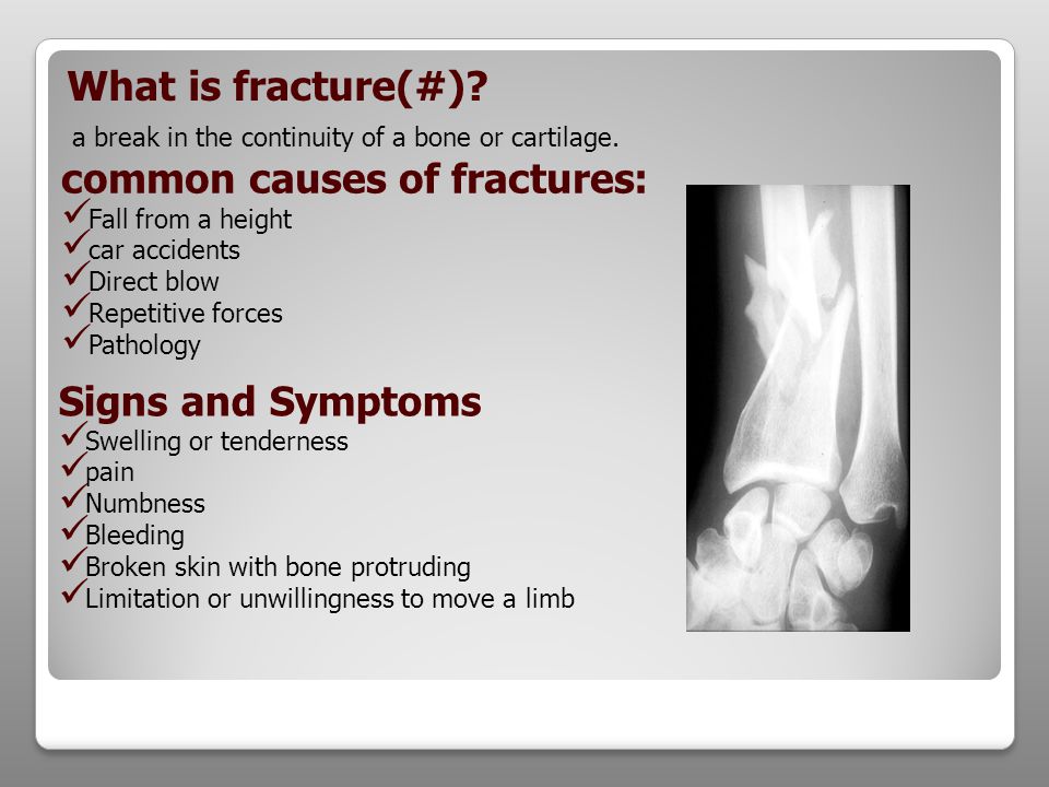 common causes of fractures 