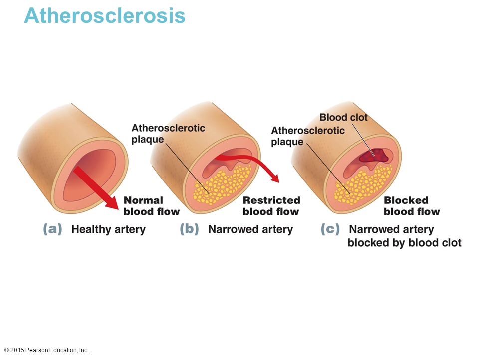 Atherosclerosis © 2015 Pearson Education, Inc.