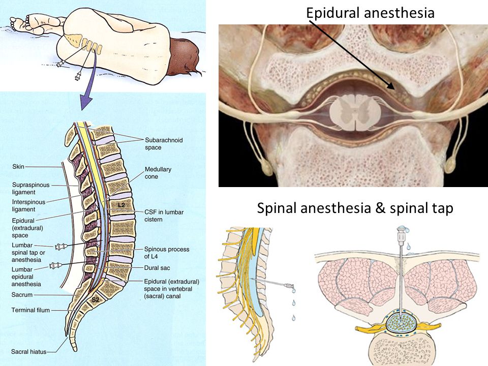 Эпидуральная спинная. Эпидуральная анестезия. Эпидуральная анестезия концентрация. Анестезия в спинной мозг.