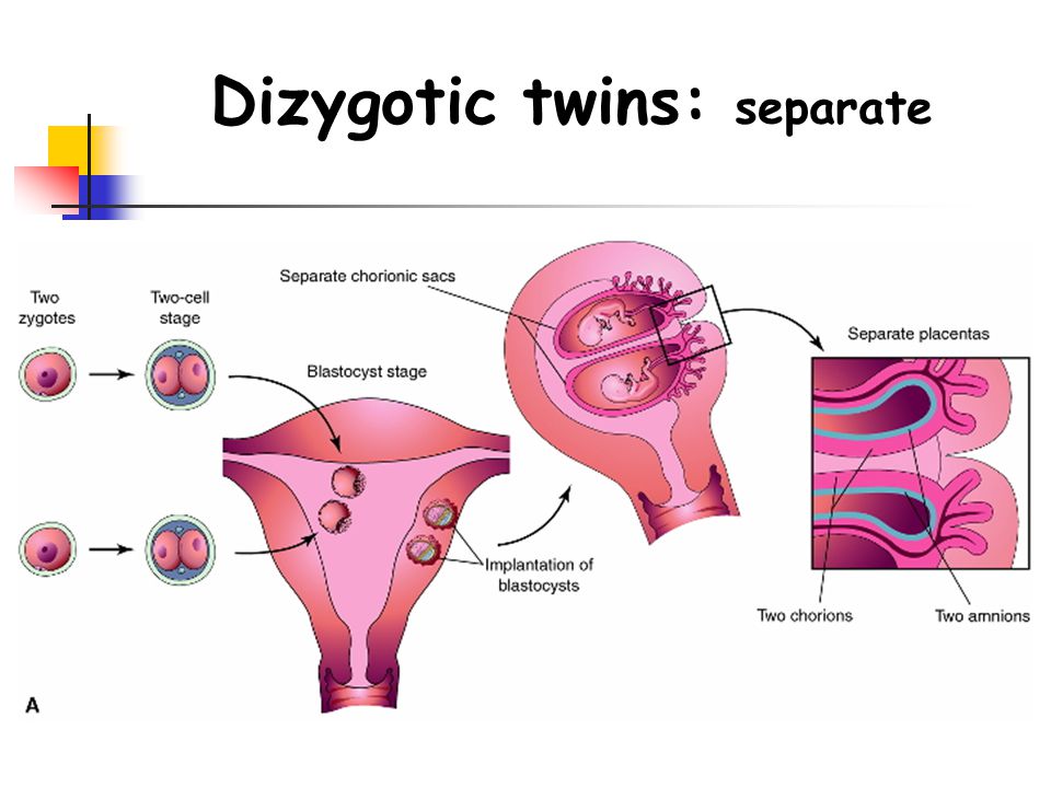 Dizygotic twins: separate