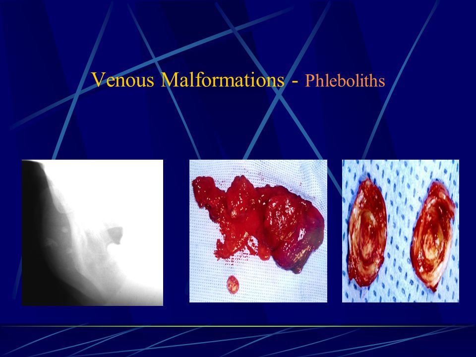 Venous Malformations - Phleboliths