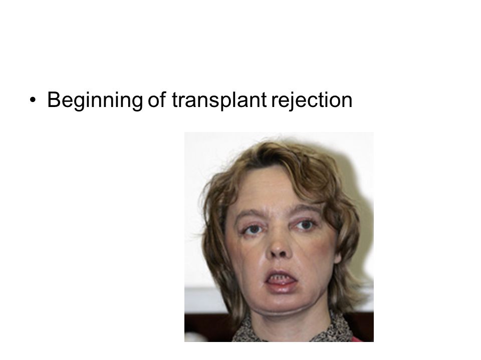 Beginning of transplant rejection