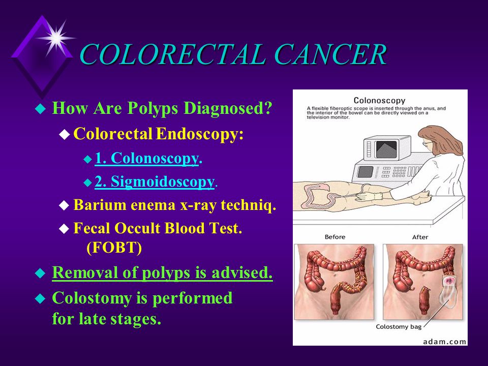 COLORECTAL CANCER How Are Polyps Diagnosed Colorectal Endoscopy: