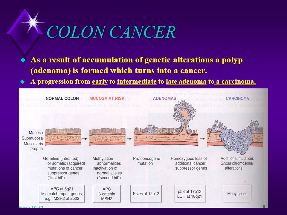 COLON CANCER As a result of accumulation of genetic alterations a polyp (adenoma) is formed which turns into a cancer.