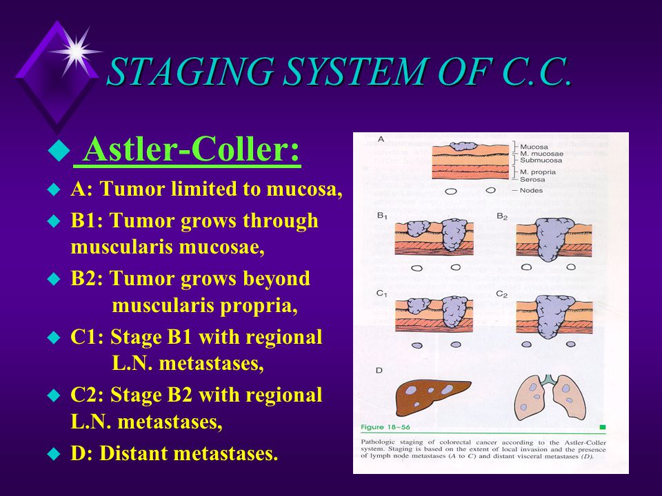 STAGING SYSTEM OF C.C. Astler-Coller: A: Tumor limited to mucosa,