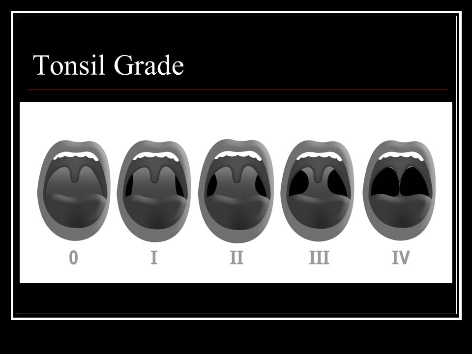 Tonsil Size Chart
