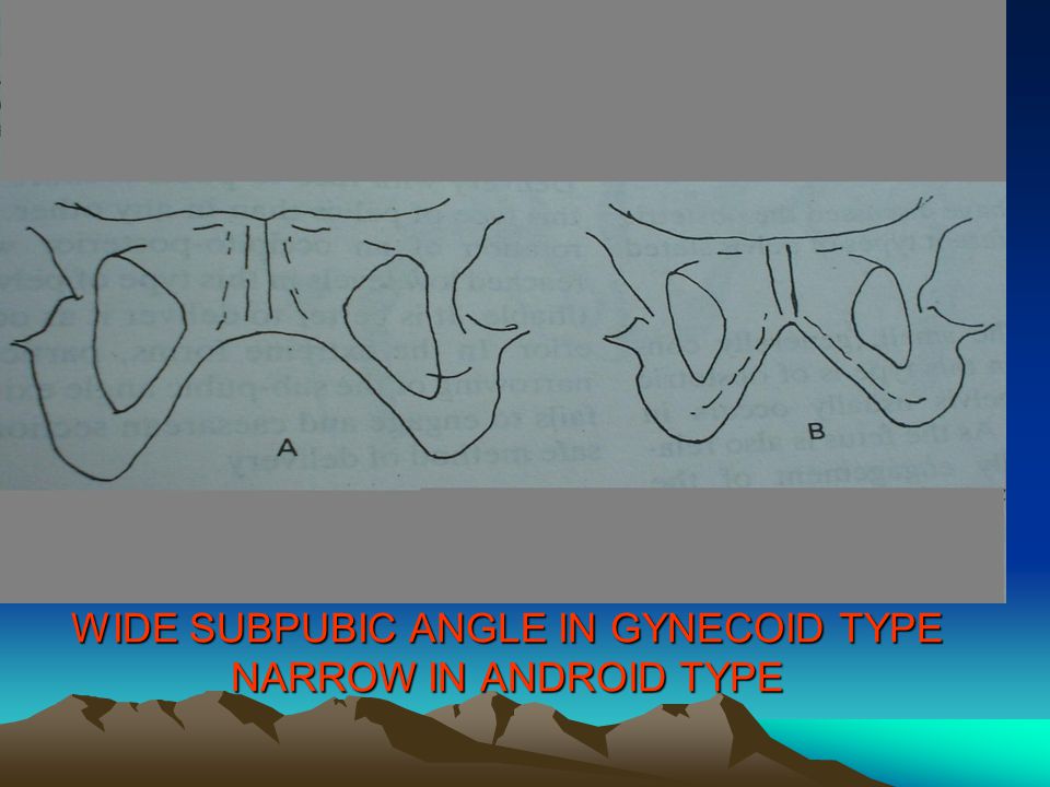 WIDE SUBPUBIC ANGLE IN GYNECOID TYPE NARROW IN ANDROID TYPE