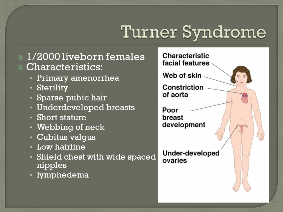 Turner Syndrome 1/2000 liveborn females Characteristics.