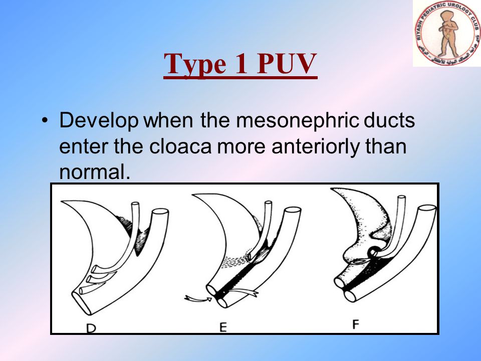 Posterior Urethral Valve Ppt Download