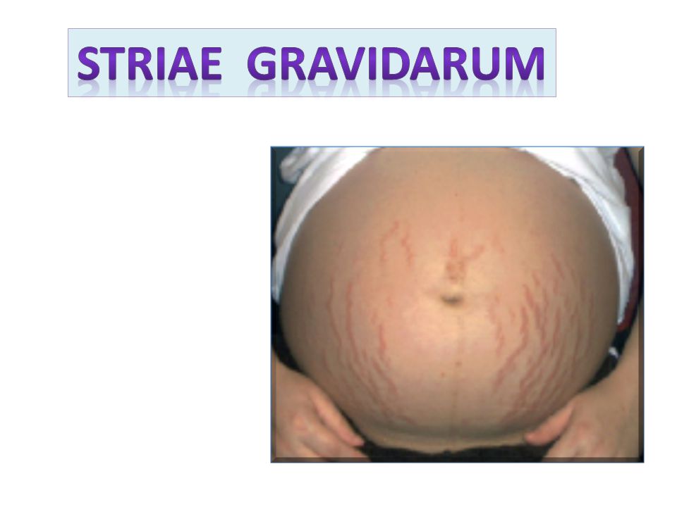 Striae gravidarum