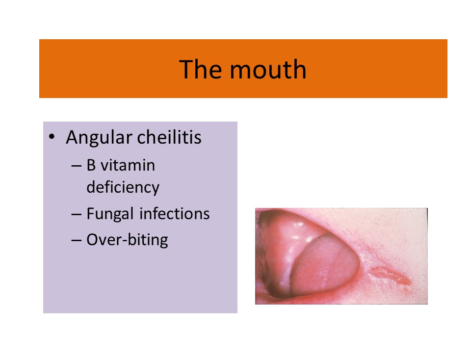 The mouth Angular cheilitis B vitamin deficiency Fungal infections