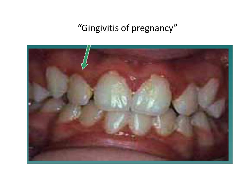 Gingivitis of pregnancy