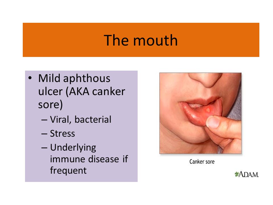 The mouth Mild aphthous ulcer (AKA canker sore) Viral, bacterial