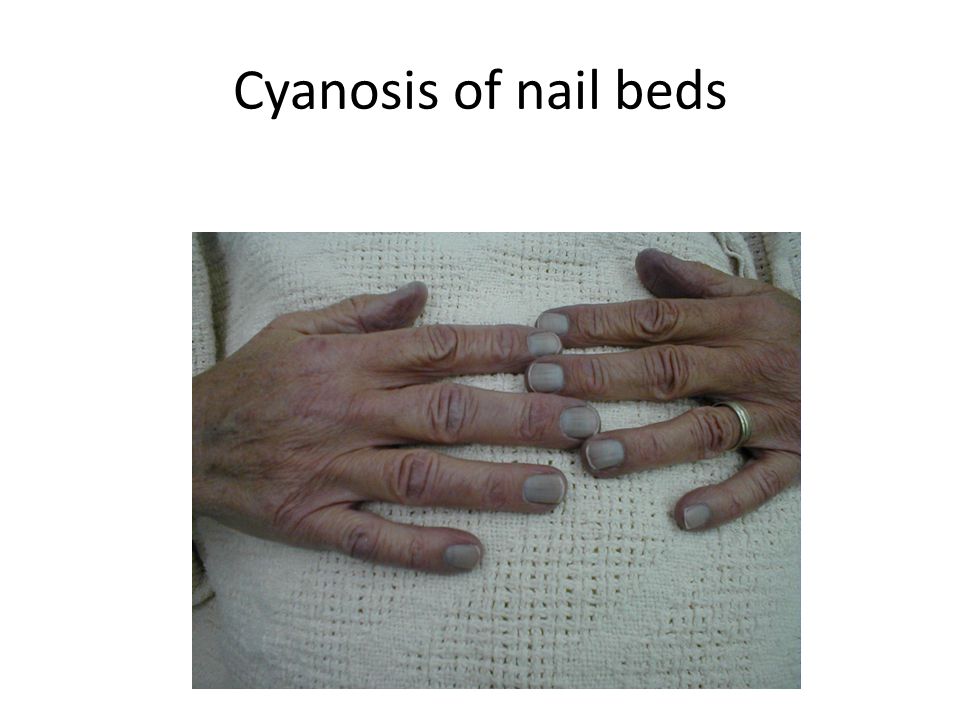Cyanosis of nail beds