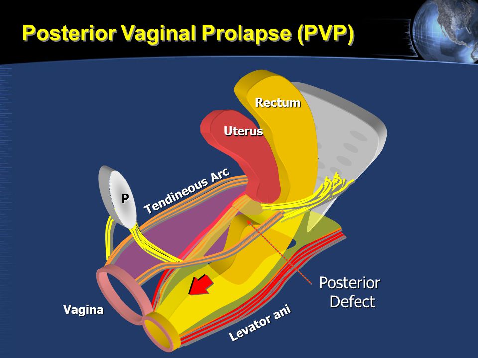 Posterior Vaginal Prolapse (PVP)