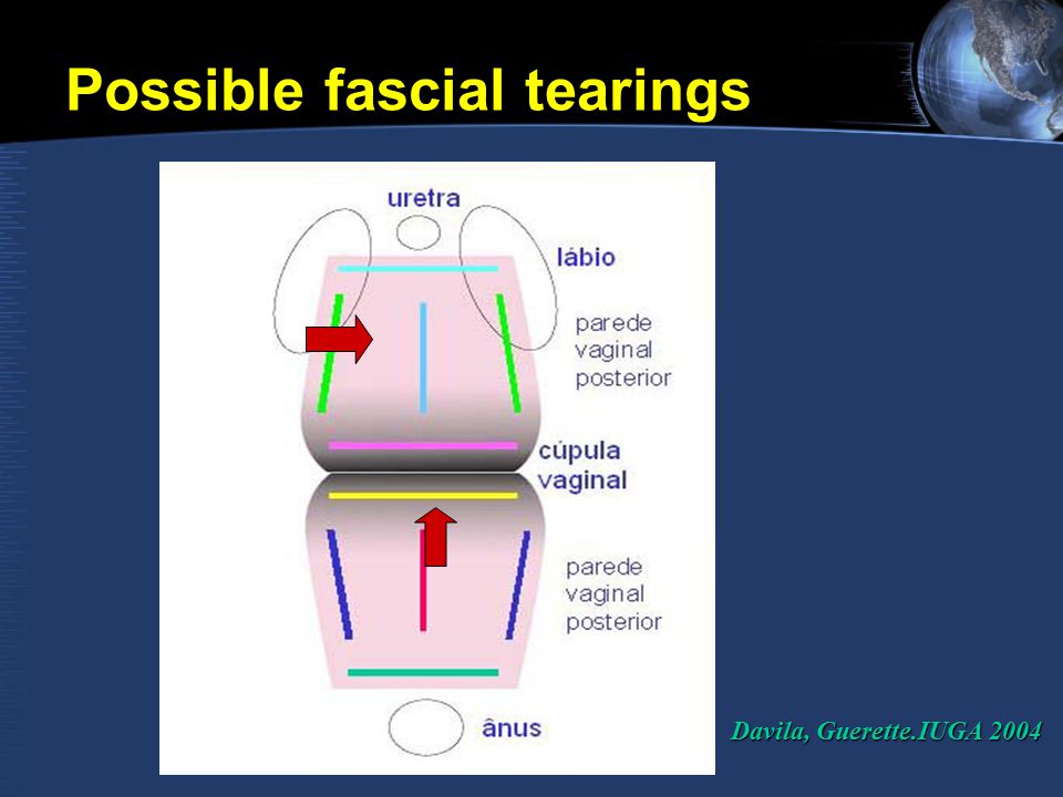 Possible fascial tearings