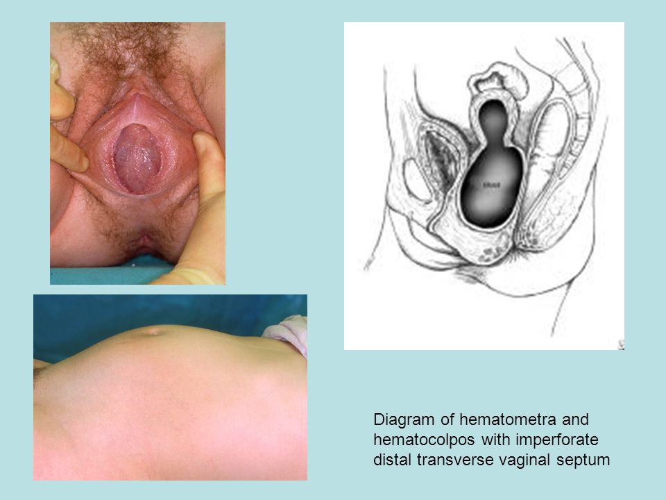 A Case Report Of Premenarchial Transverse Vaginal Septum
