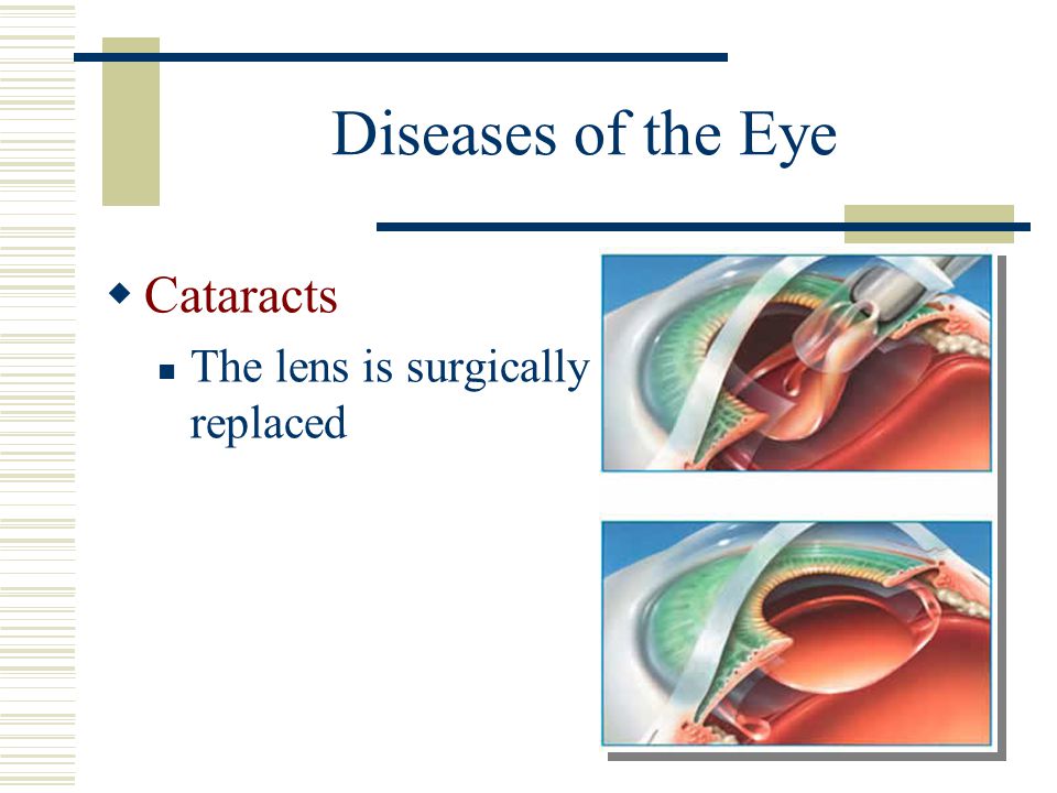 Diseases of the Eye Cataracts The lens is surgically replaced