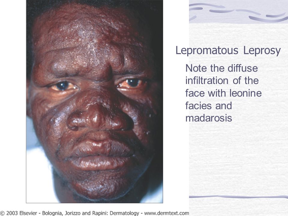 Mycobacteria Tuberculosis And Leprosy Ppt Video Online Download