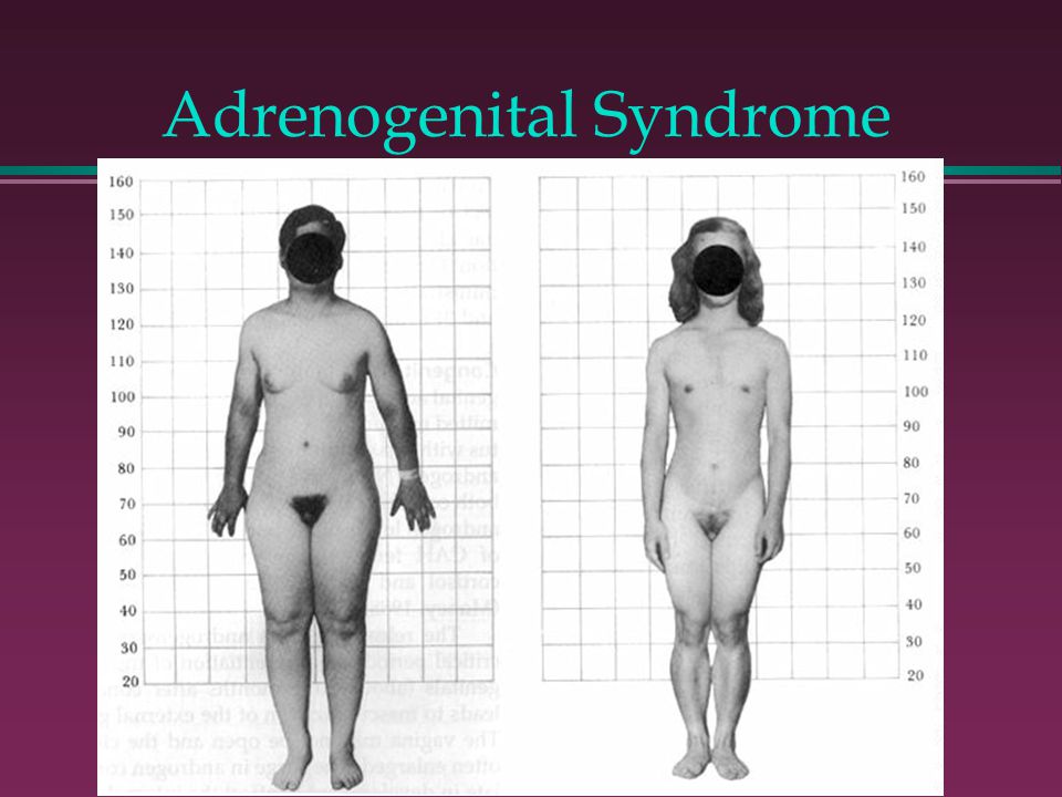 Nude Down Syndrome Girls