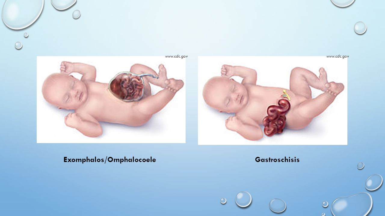 Exomphalos/Omphalocoele Gastroschisis