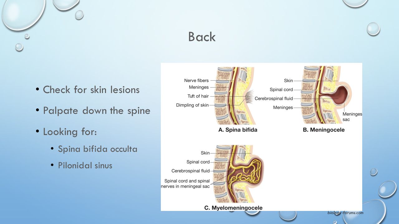Back Check for skin lesions Palpate down the spine Looking for: