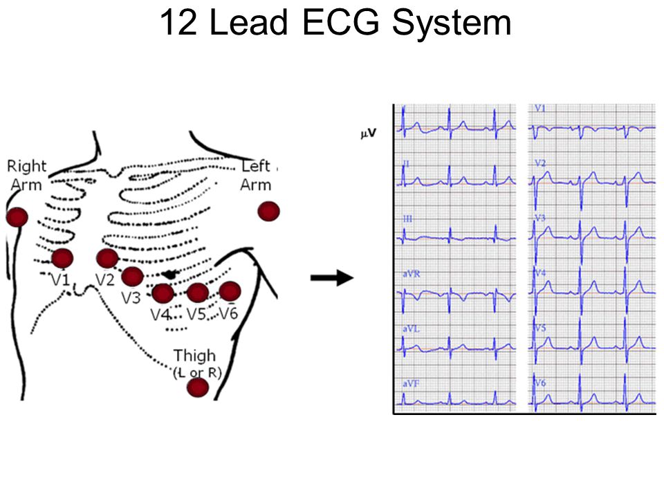 Поворот сердца правым желудочком вперед что это. Нормальная ЭКГ В 12 отведениях. Электрокардиограмма в 12 отведениях. Нормальная ЭКГ 12 отведений рисунок. Отведения сердца на ЭКГ.