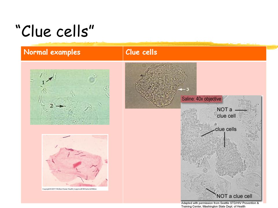Clue cells Normal examples Clue cells
