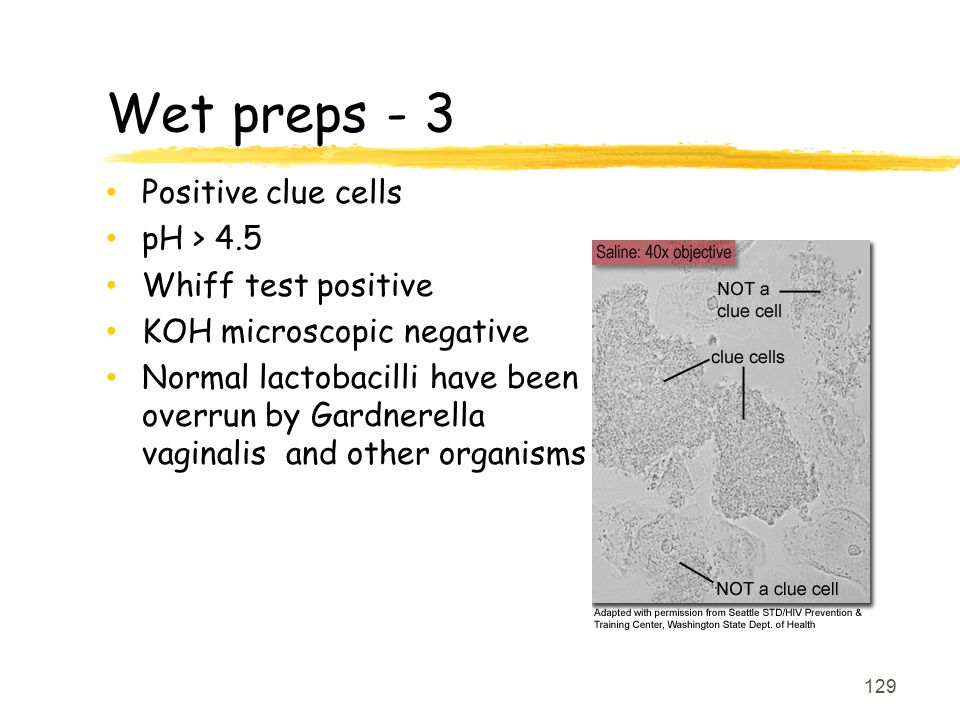 Wet preps - 3 Positive clue cells pH > 4.5 Whiff test positive