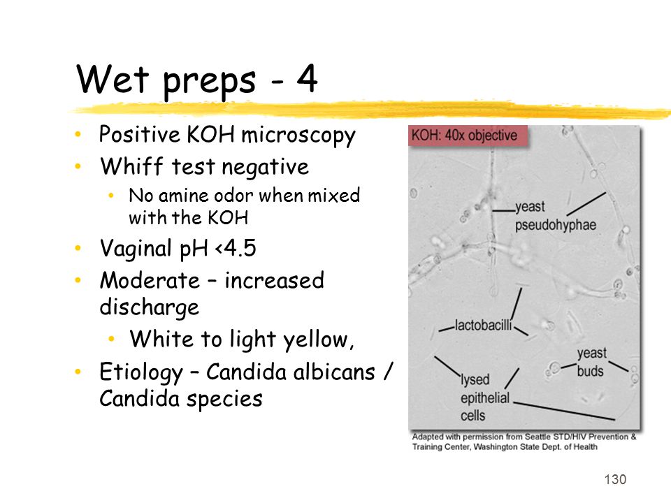 Wet preps - 4 Positive KOH microscopy Whiff test negative