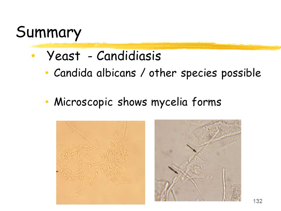 Summary Yeast - Candidiasis Candida albicans / other species possible
