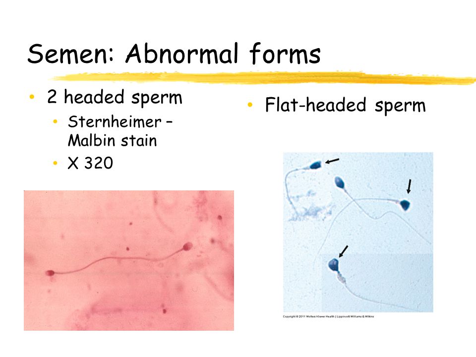 Semen: Abnormal forms 2 headed sperm Flat-headed sperm