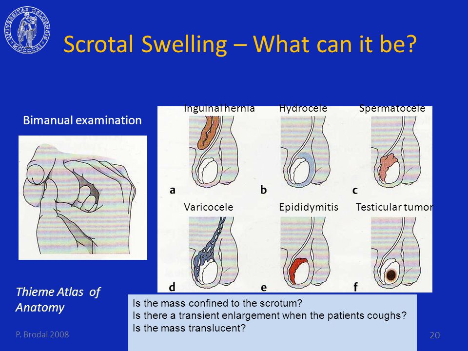 Scrotal Swelling - What can it be.