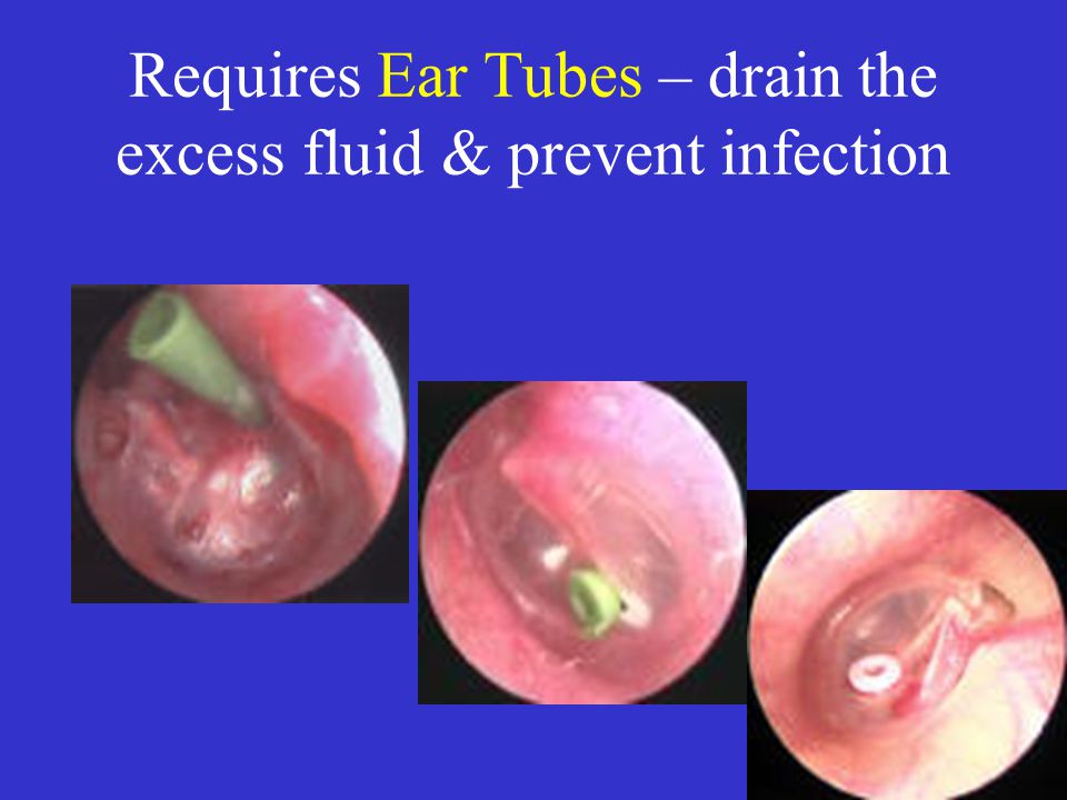 Requires Ear Tubes – drain the excess fluid & prevent infection