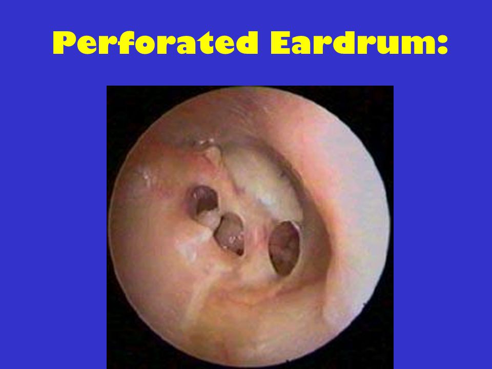 Perforated Eardrum: ruptured