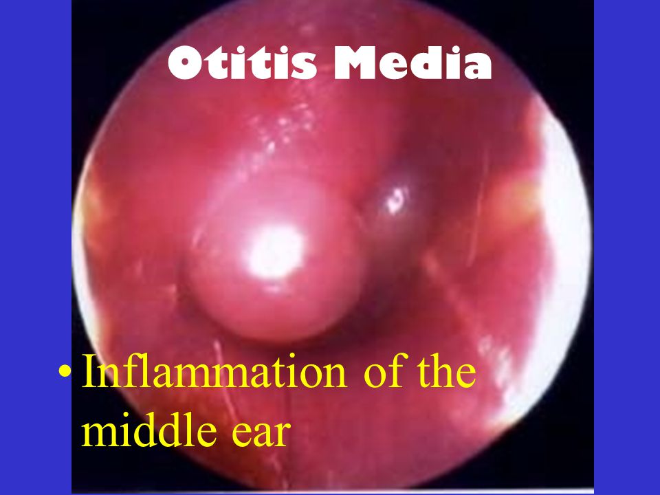 Inflammation of the middle ear