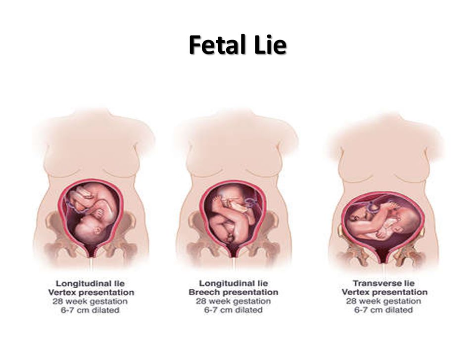 Fetal Lie