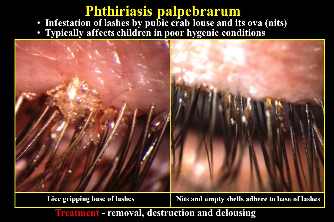 Nits In Eyelashes | www.pixshark.com - Images Galleries ...