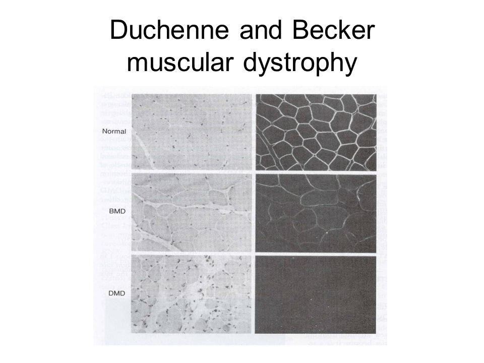 Duchenne and Becker muscular dystrophy