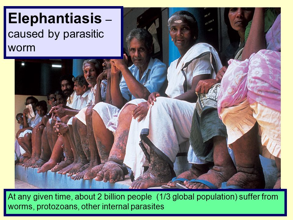 Elephantiasis – caused by parasitic worm