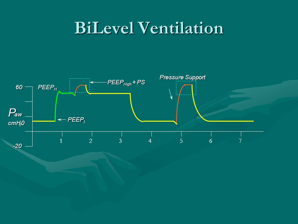 New Modes of Mechanical Ventilation - ppt video online download