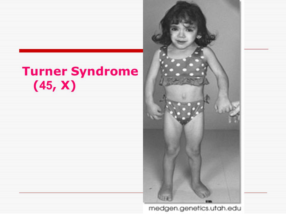 A 7-year-old girl with pterygium colli associated with Turner syndrome. Download