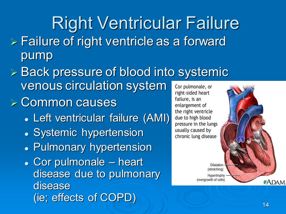 Right Ventricular Failure