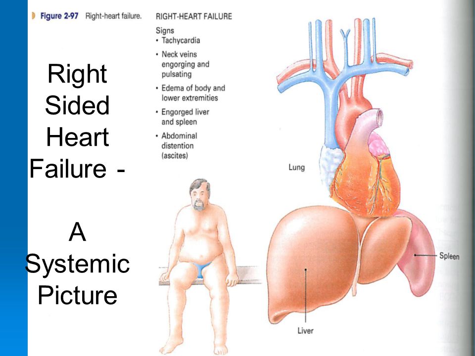 Right Sided Heart Failure - A Systemic Picture