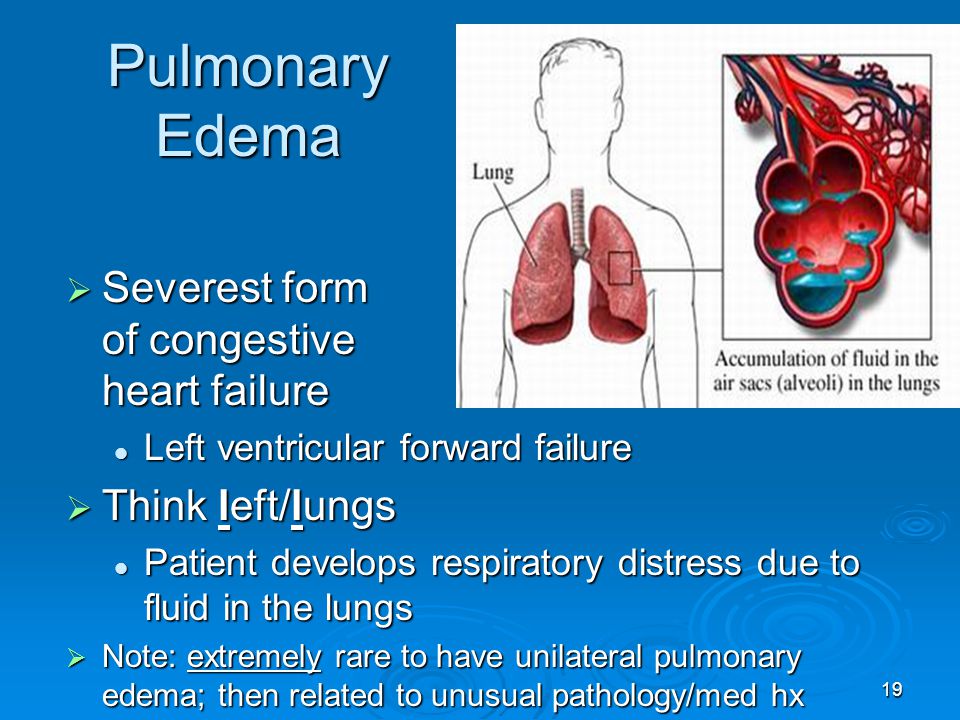 Pulmonary Edema Severest form of congestive heart failure