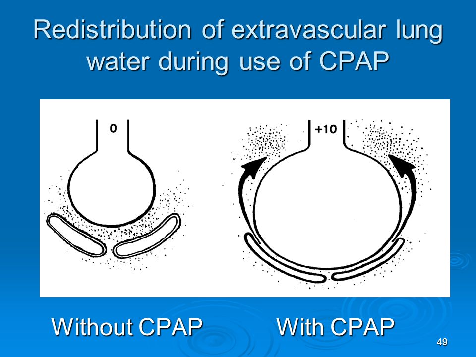 Redistribution of extravascular lung water during use of CPAP
