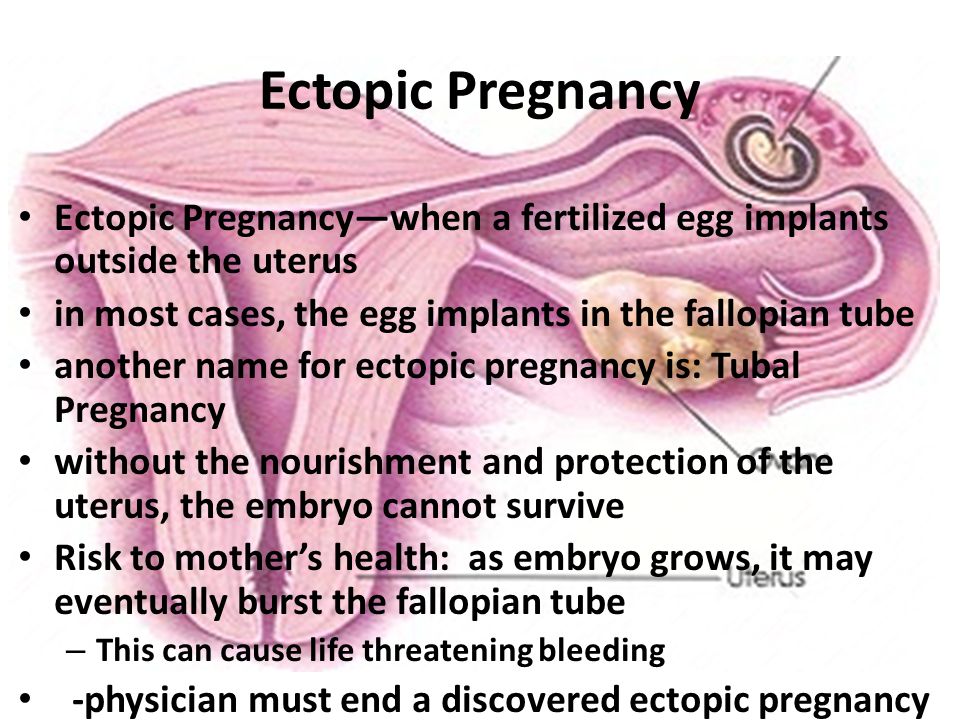 Ectopic Pregnancy Ectopic Pregnancy—when a fertilized egg implants outside the uterus. in most cases, the egg implants in the fallopian tube.